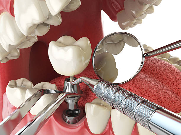 Best Emergency Broken Tooth Repair in New Glarus, WI